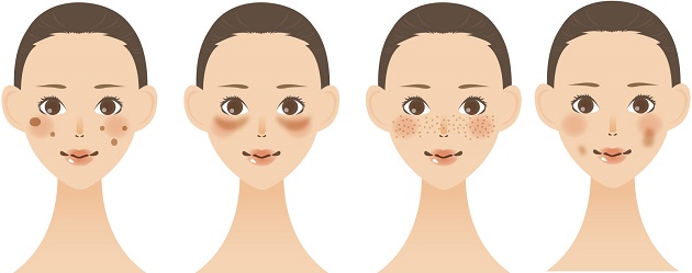 様々なシミの女性例